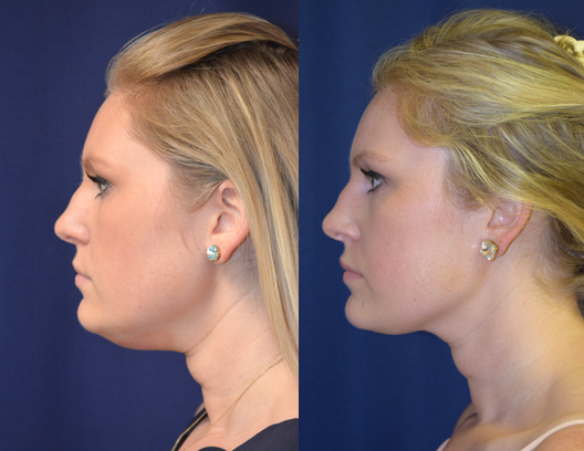 Kybella vs coolsculpting: Which is best for fat reduction?